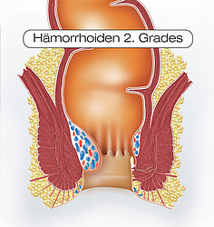 Schaubild Hämorrhoiden 2. Grades