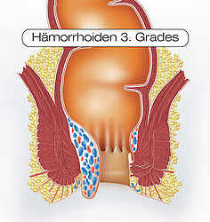 Schaubild Hämorrhoiden 3. Grades