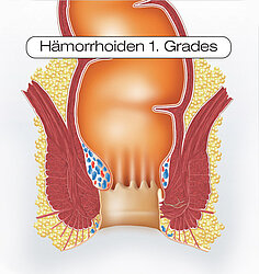 Schaubild Hämorrhoiden 1. Grades