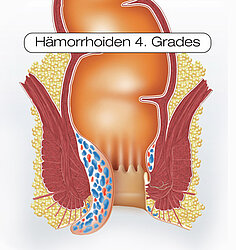 Schaubild Hämorrhoiden 4. Grades