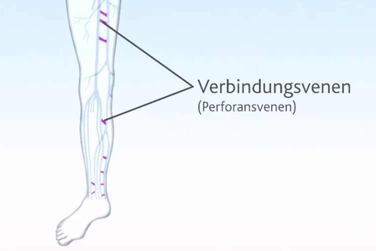 Perforansvenen verbinden die oberflächlichen und tiefen Venen an bestimmten Stellen