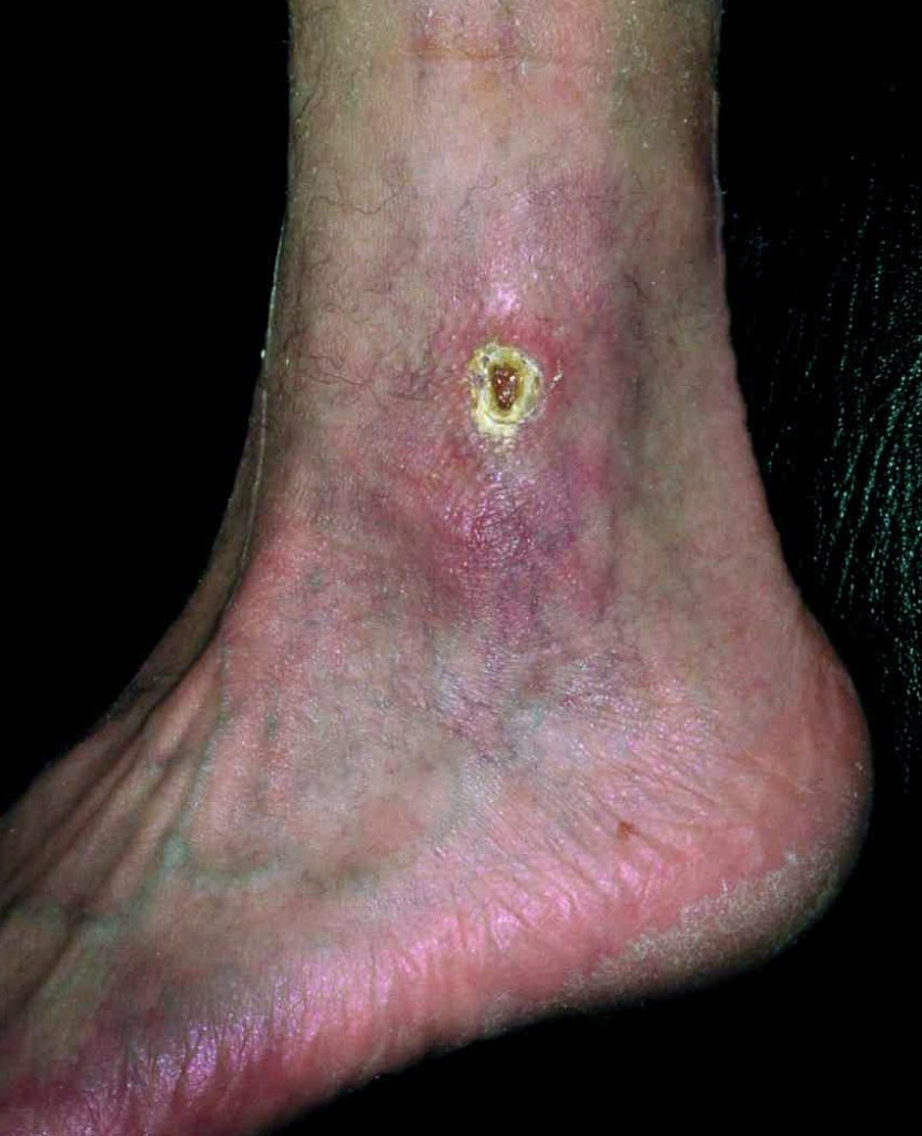 Postthrombotisches Syndrom