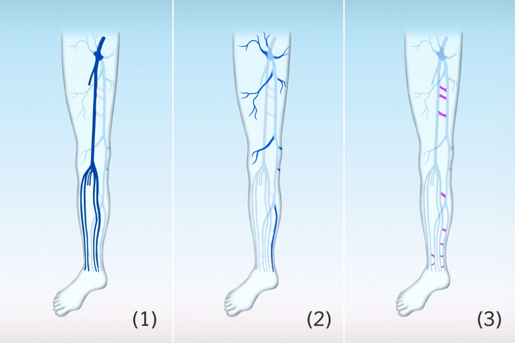 Tiefe Venen (1), oberflächliche Venen (2), Verbindungsvenen oder Perforansvenen (3)